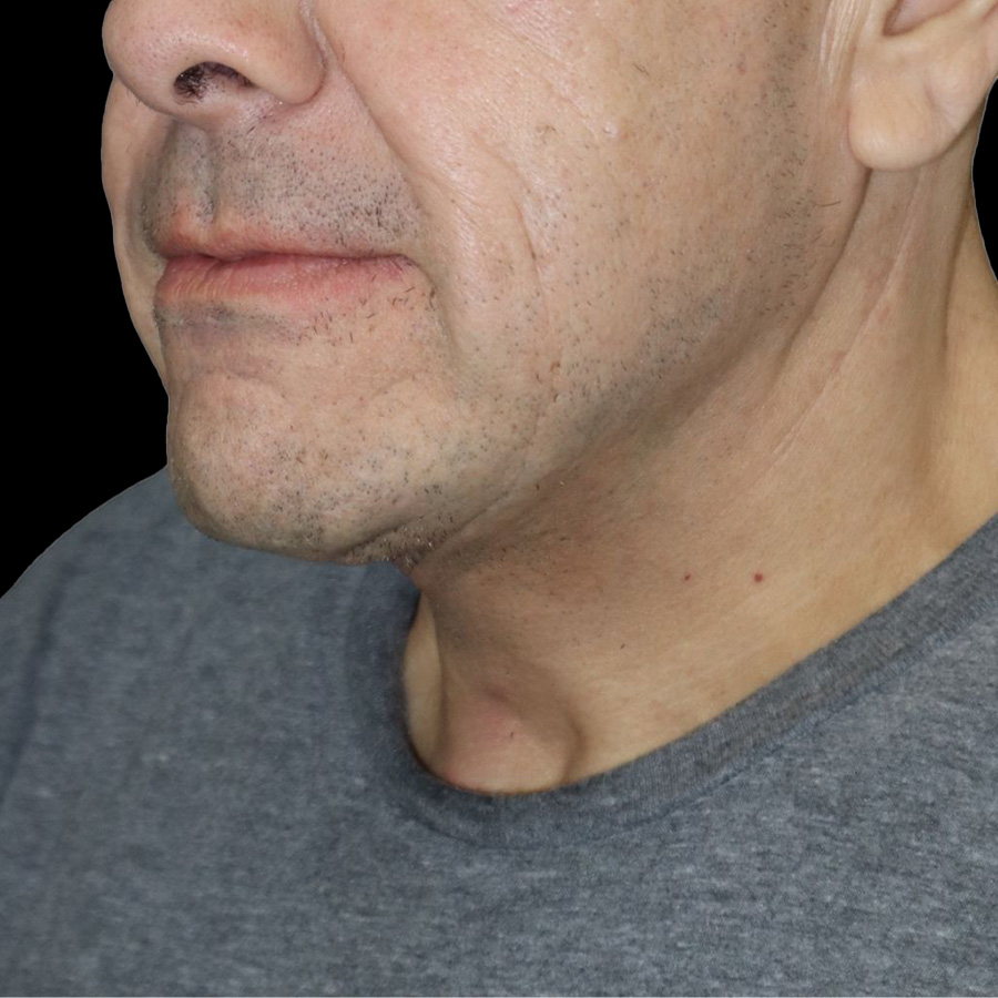 Case--1601 | After Neck Lift