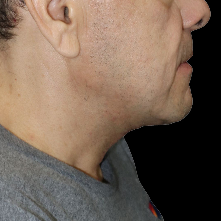 Case--1601 | After Neck Lift 2