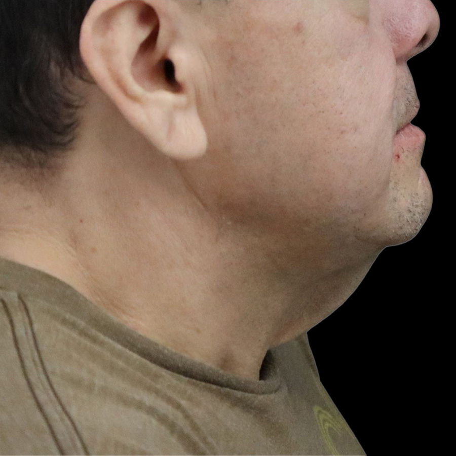 Case--1601 | Before Neck Lift 2