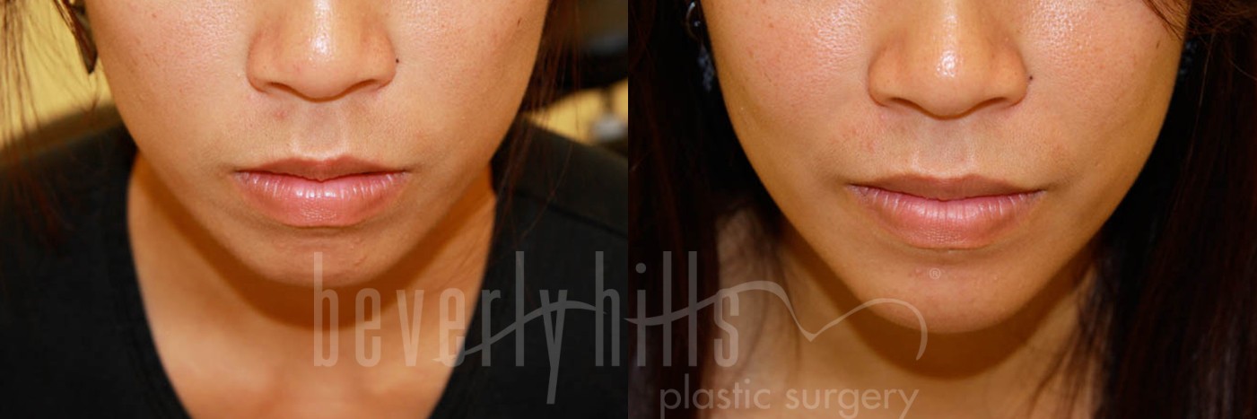 Non-Surgical Patient 01 Before & After
