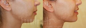 Non-Surgical Patient 01 Before & After - Thumbnail
