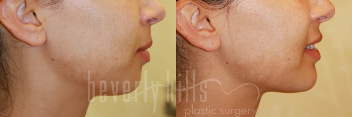 Non-Surgical Patient 01 Before & After