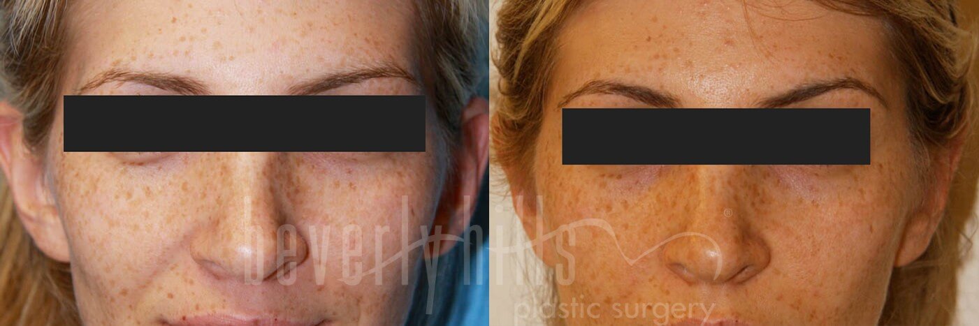 Otoplasty Patient 01 Before & After