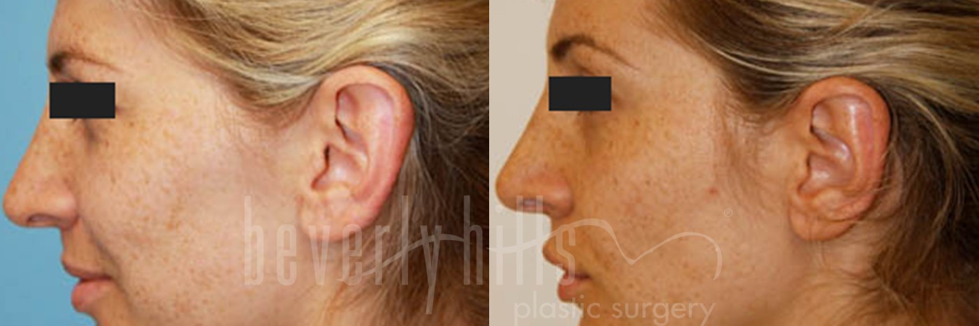 Otoplasty Patient 01 Before & After