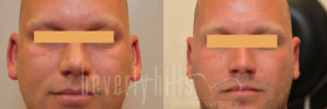 Otoplasty Patient 05 Before & After - Thumbnail