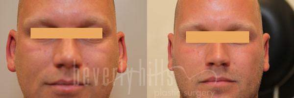 Otoplasty Patient 05 Before & After