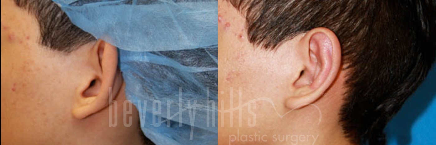 Otoplasty Patient 03 Before & After