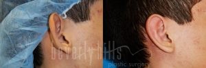 Otoplasty Patient 03 Before & After - Thumbnail