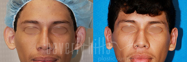 Otoplasty Patient 06 Before & After