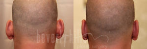 Otoplasty Patient 05 Before & After - Thumbnail