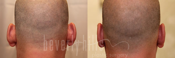 Otoplasty Patient 05 Before & After