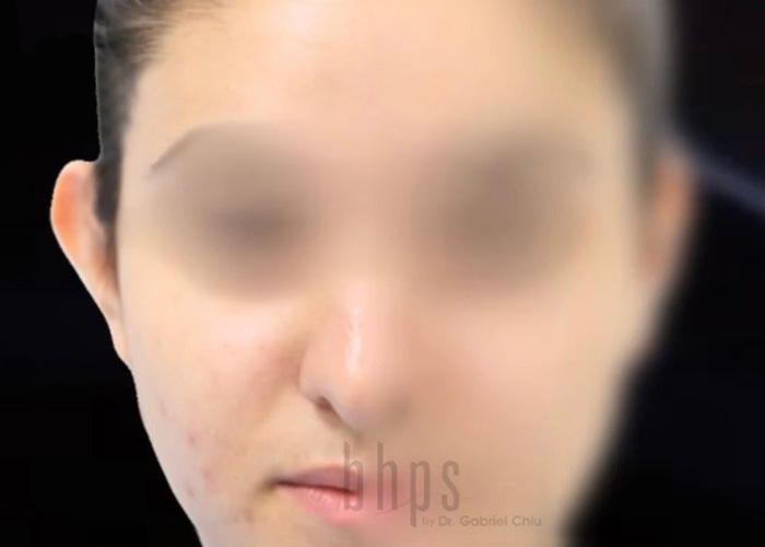 Ear Surgery Patient Before - 1