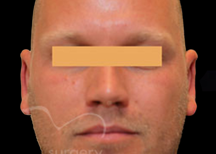 Case--8352 | After Otoplasty