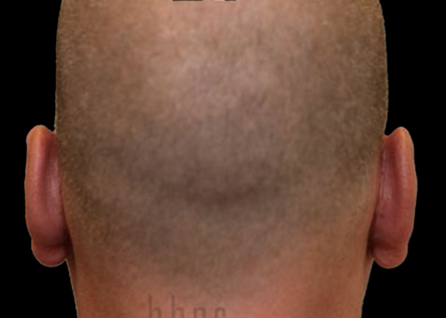 Case--8352 | After Otoplasty 2