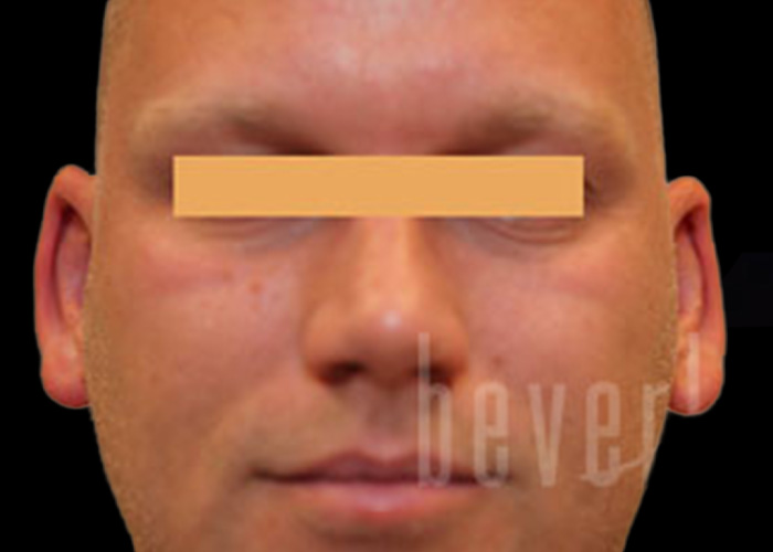 Case--8352 | Before Otoplasty