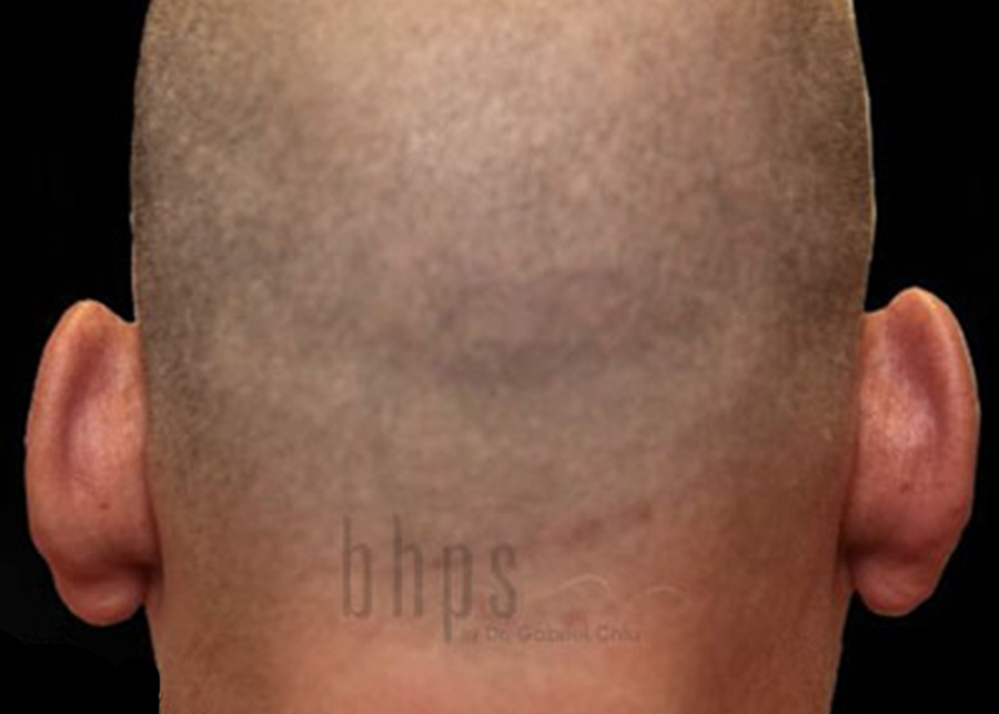 Case--8352 | Before Otoplasty 2