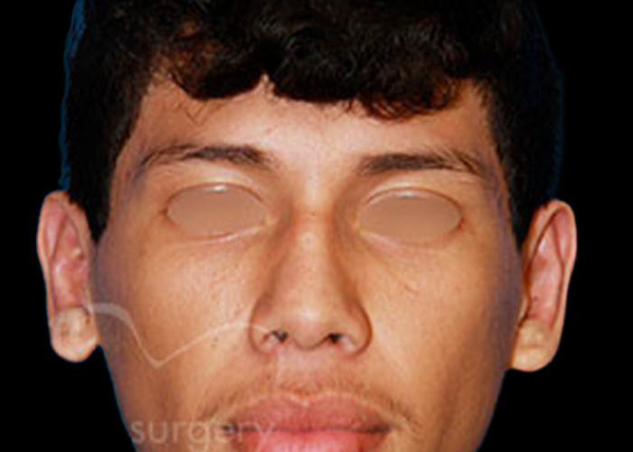 Case--1357 | After Otoplasty