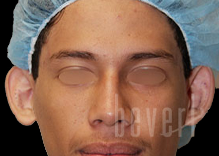 Case--1357 | Before Otoplasty