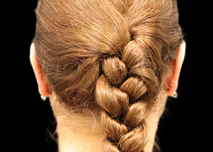 Case--7991 | After Otoplasty 2