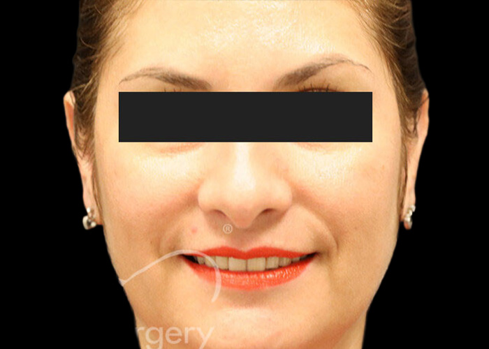 Case--7991 | After Otoplasty