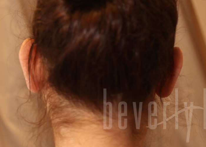 Case--7991 | Before Otoplasty 2