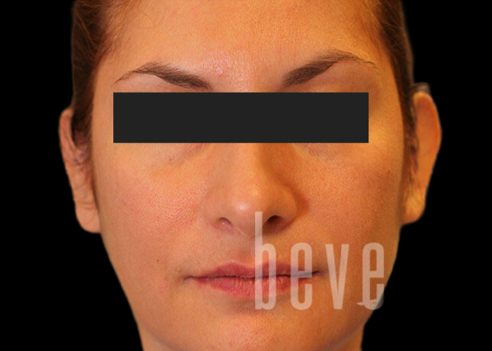 Case--7991 | Before Otoplasty
