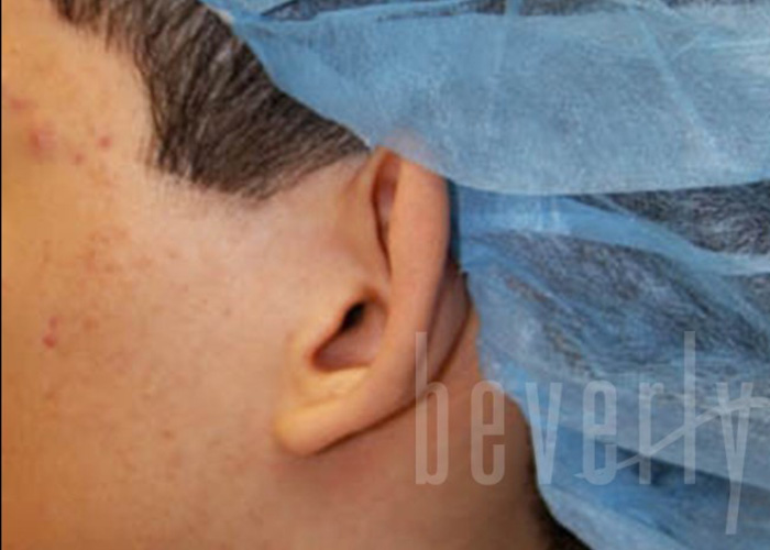 Case--3931 | Before Otoplasty 2