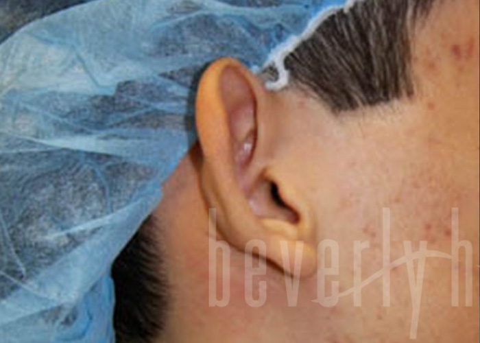 Case--3931 | Before Otoplasty