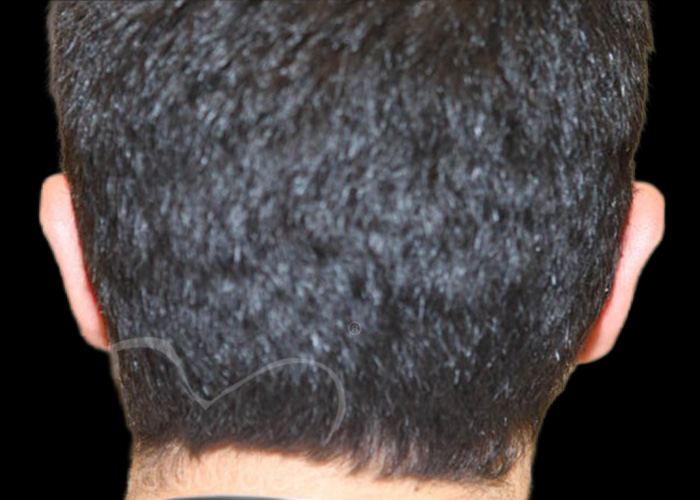 Case--7874 | After Otoplasty