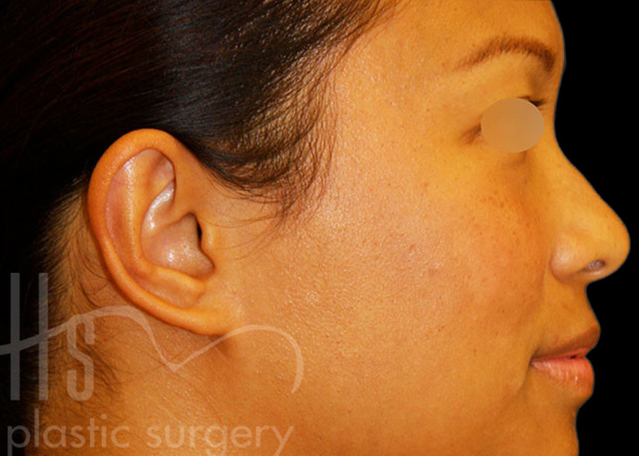 Case--4200 | After Otoplasty 2
