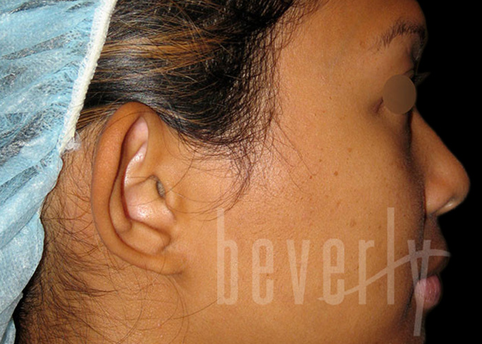 Case--4200 | Before Otoplasty 2