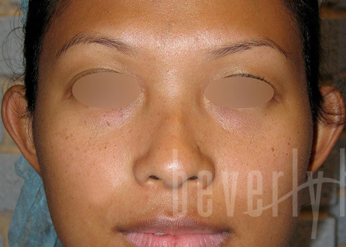 Case--4200 | Before Otoplasty