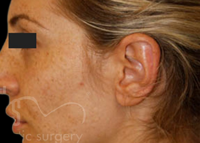 Case--9309 | After Otoplasty 2