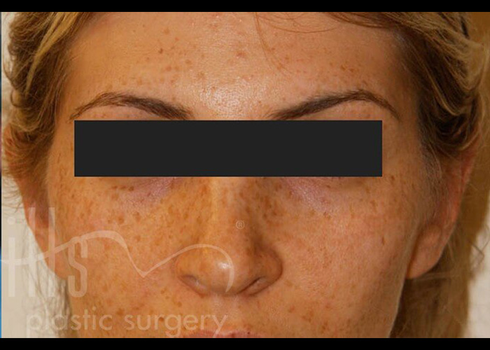 Case--9309 | After Otoplasty