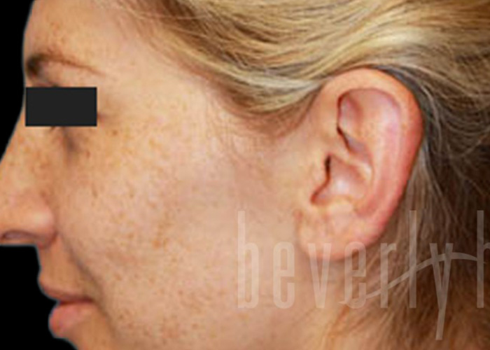 Case--9309 | Before Otoplasty 2