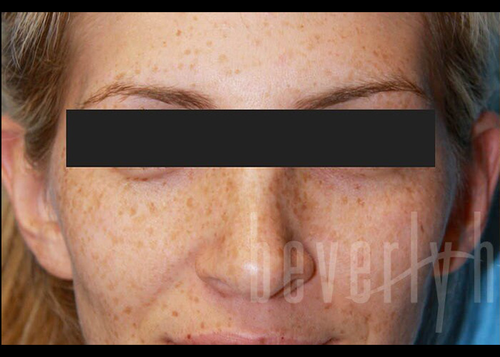 Case--9309 | Before Otoplasty