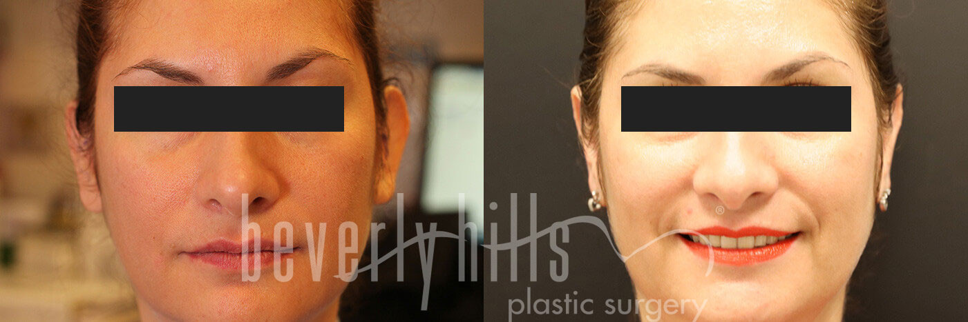 Otoplasty Patient 04 Before & After