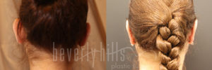 Otoplasty Patient 04 Before & After - Thumbnail