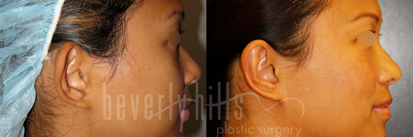 Otoplasty Patient 07 Before & After