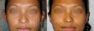 Otoplasty Patient 07 Before & After - Thumbnail