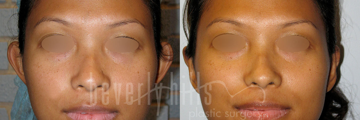 Otoplasty Patient 07 Before & After