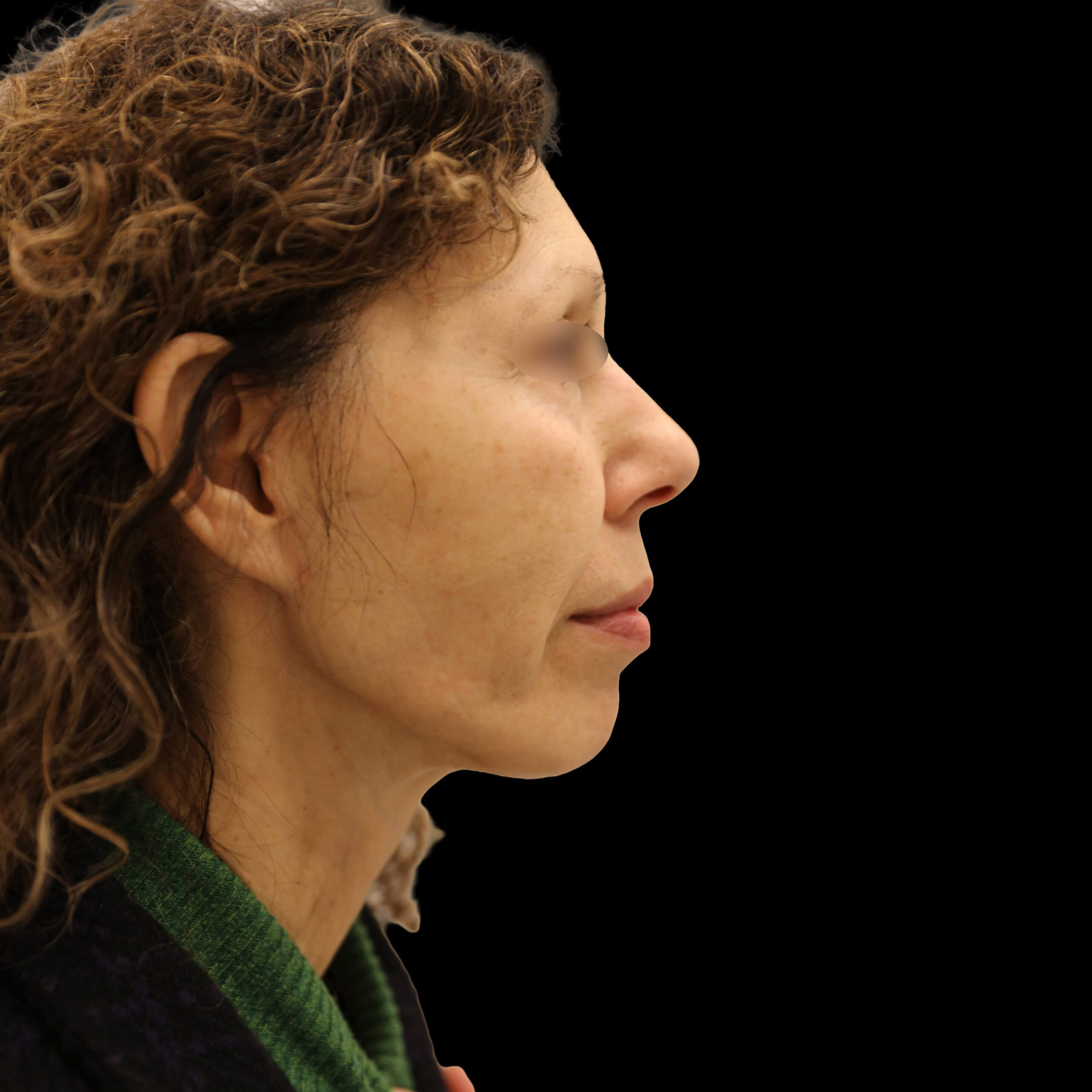 Neck Lift Patient After - 2