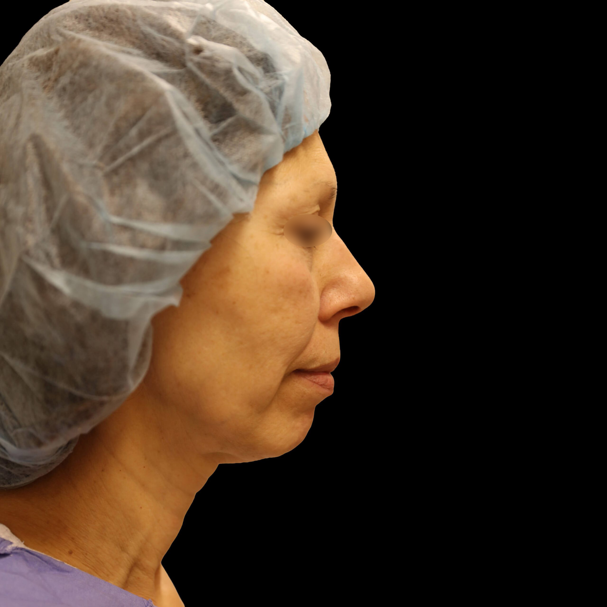 Neck Lift Patient Before - 2
