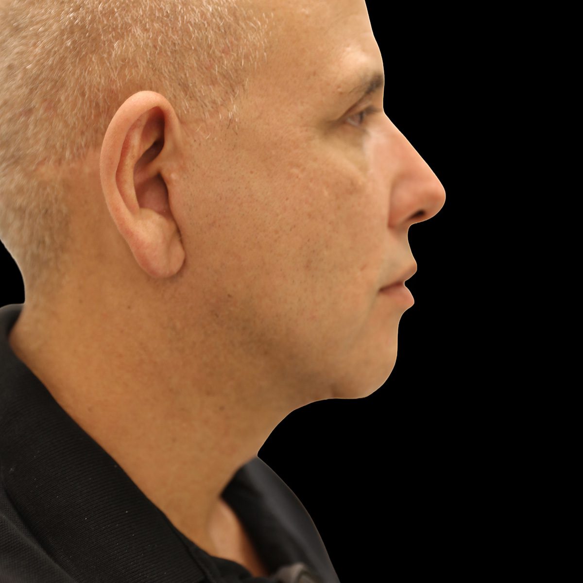 Case--5424 | After Neck Lift