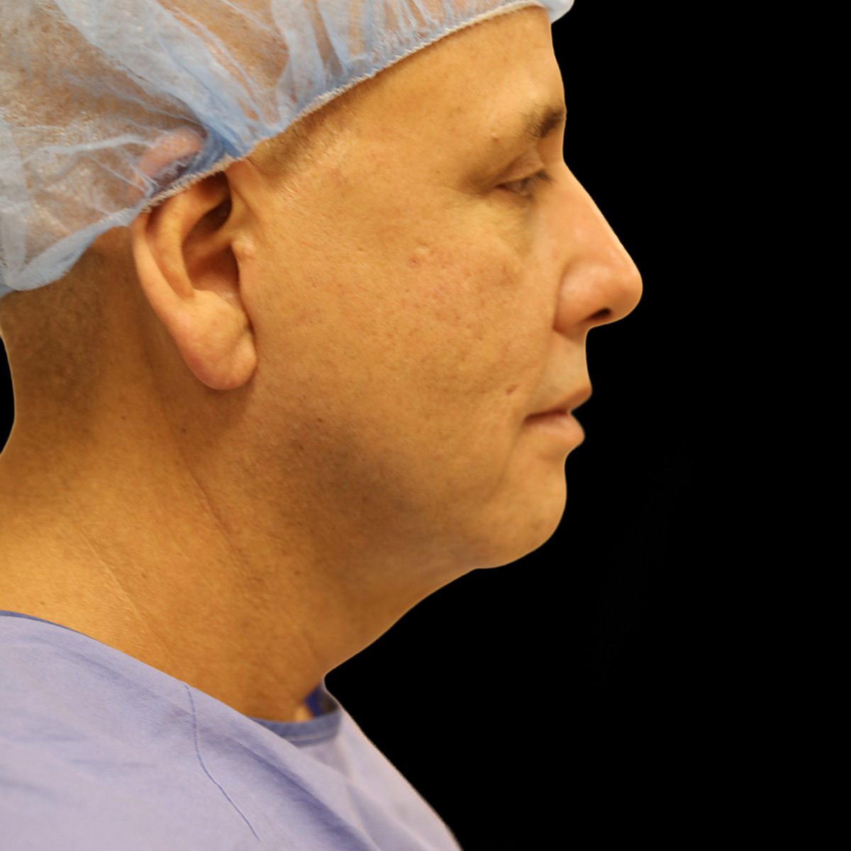 Case--5424 | Before Neck Lift