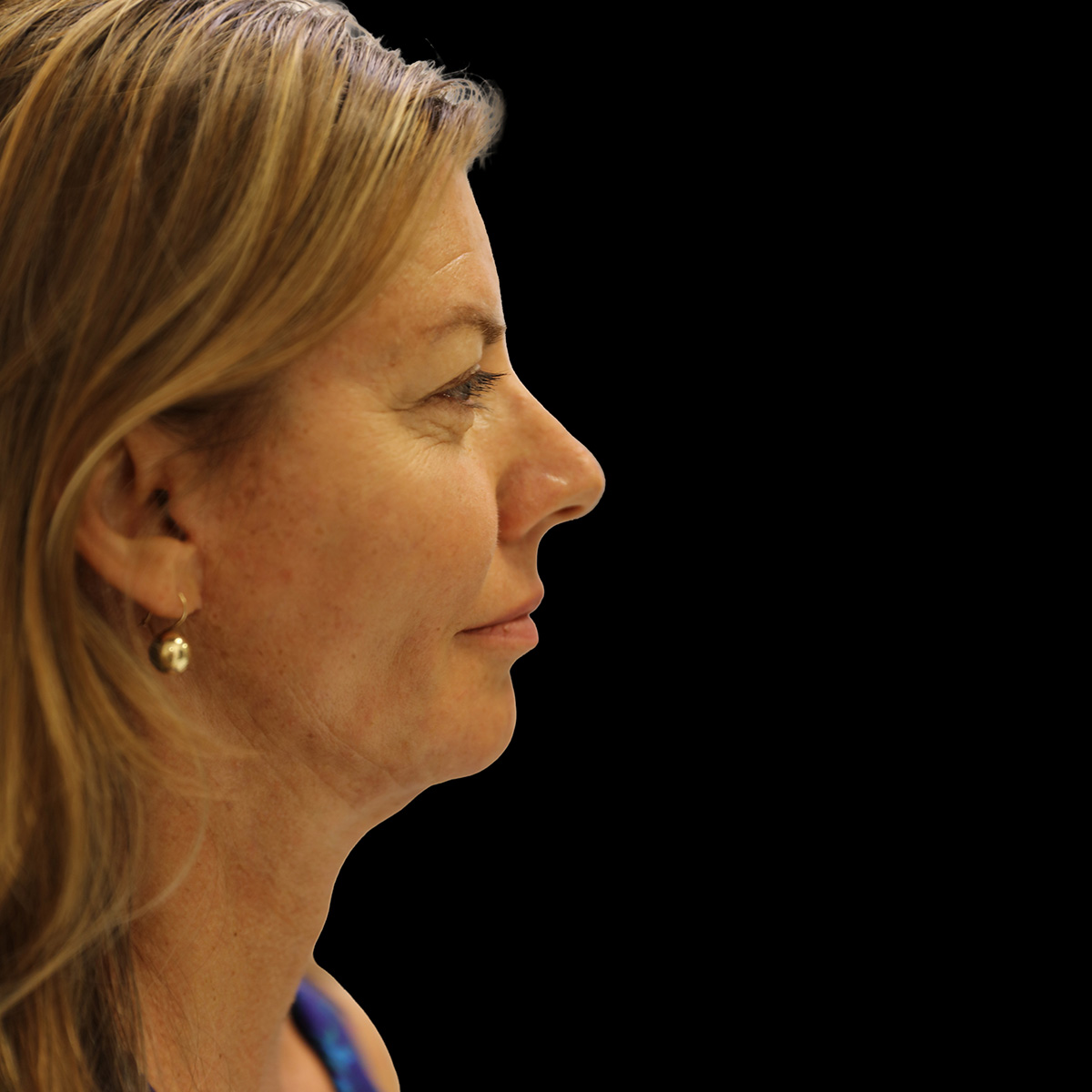 Case--8092 | After Face and Neck Lift 2