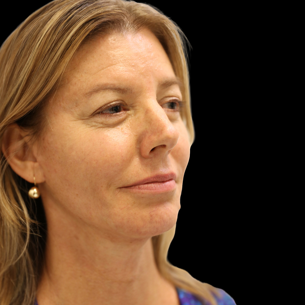 Facelift Patient After - 2