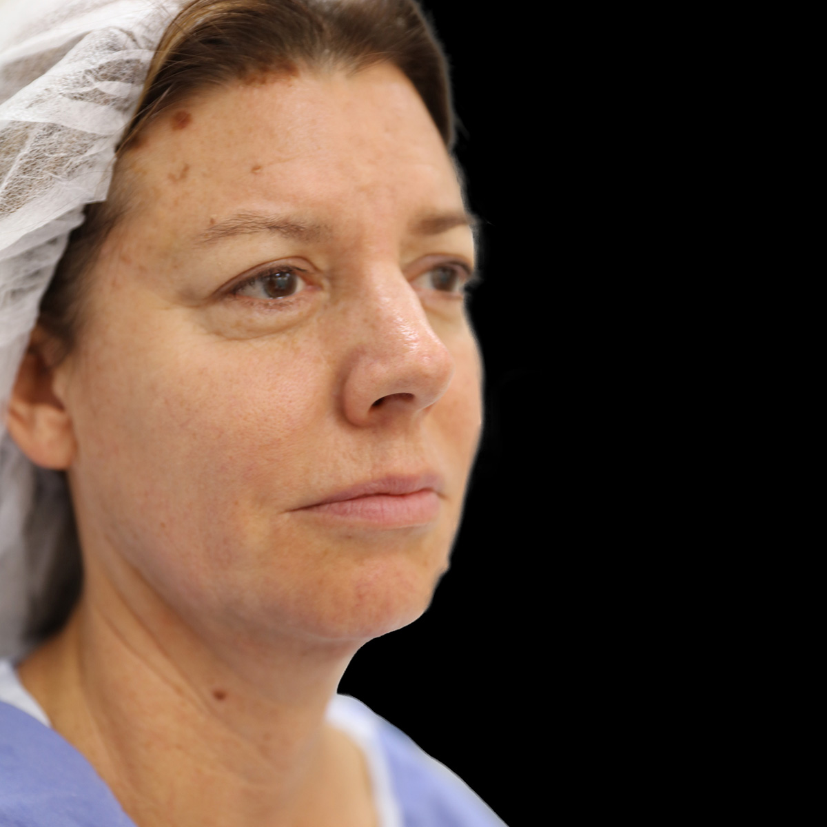 Facelift Patient Before - 2