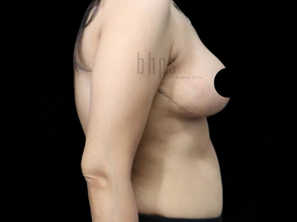 Case--5170 | After Breast Reduction 2