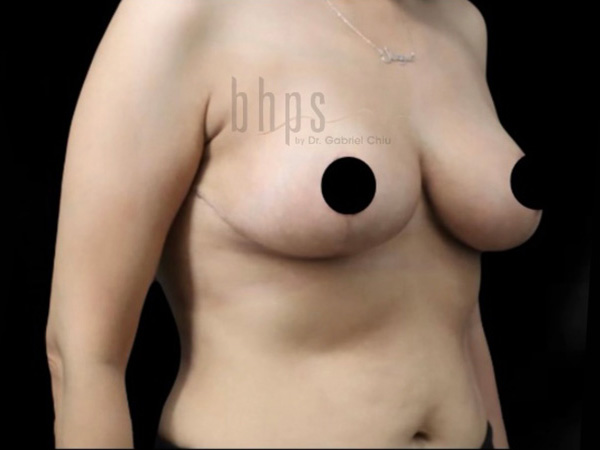 Case--5170 | After Breast